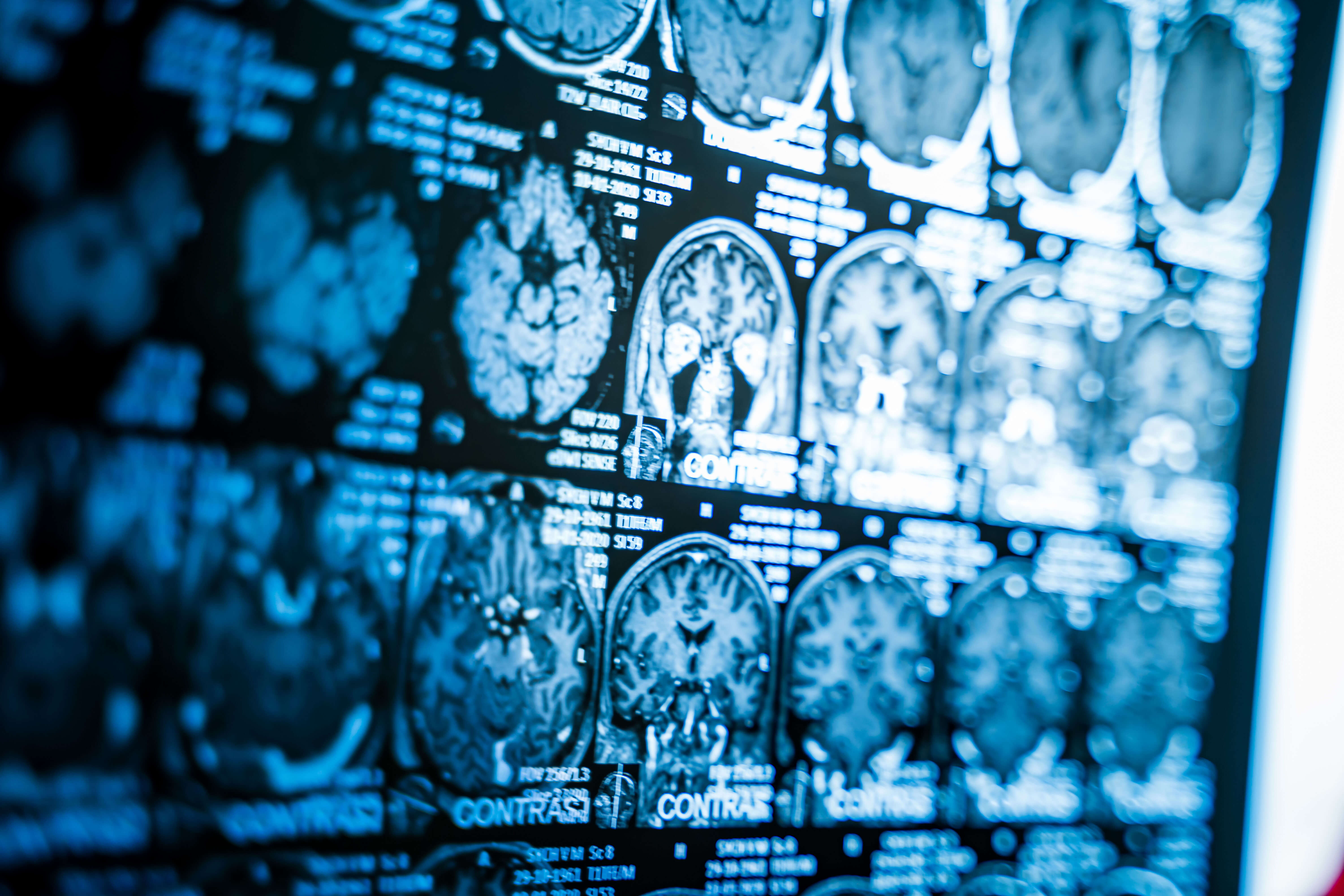 CT Scans of Brain